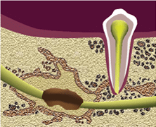 dental cavitations
