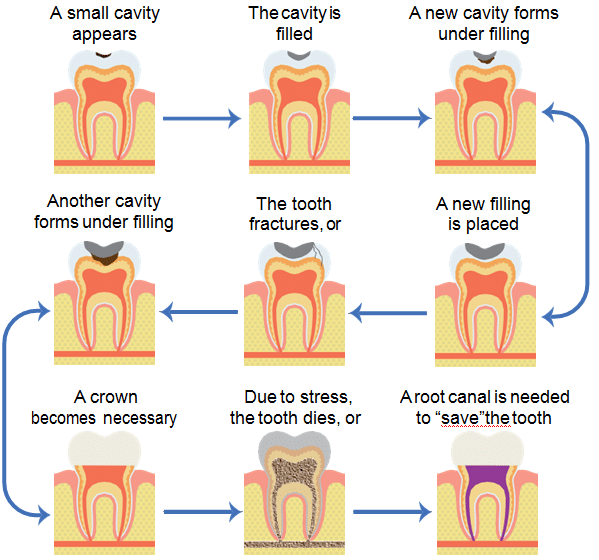 Diagram of Traditional Dentistry Restoration