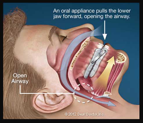 Oral Sleep Appliance