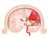 Brain Abscess