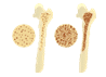 Osteoporosis