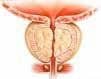 Prostatitis