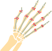 Rheumatoid Arthritis