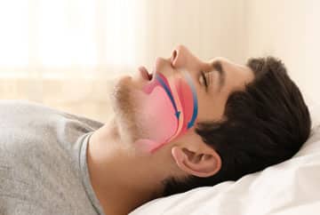 Questions about Sleep Apnea