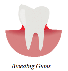 bleeding gums