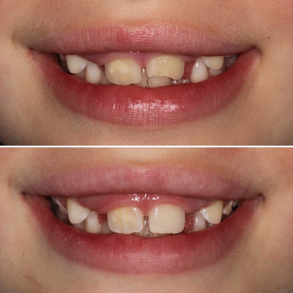 What Are Veneers? Total Care Dental Holistic Dentistry