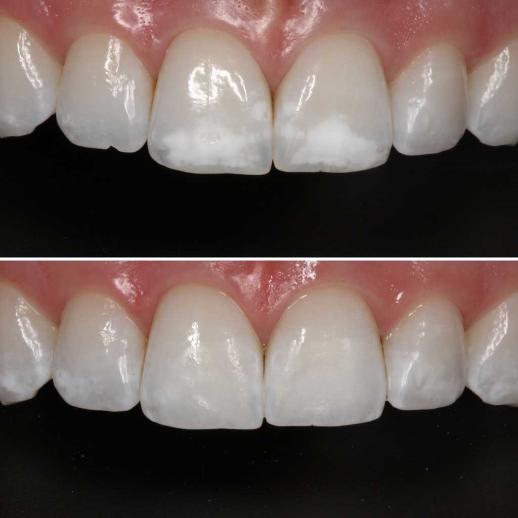 What Are Veneers? Total Care Dental Holistic Dentistry