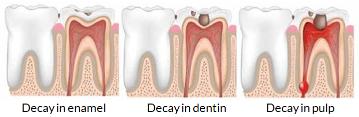 tooth decay