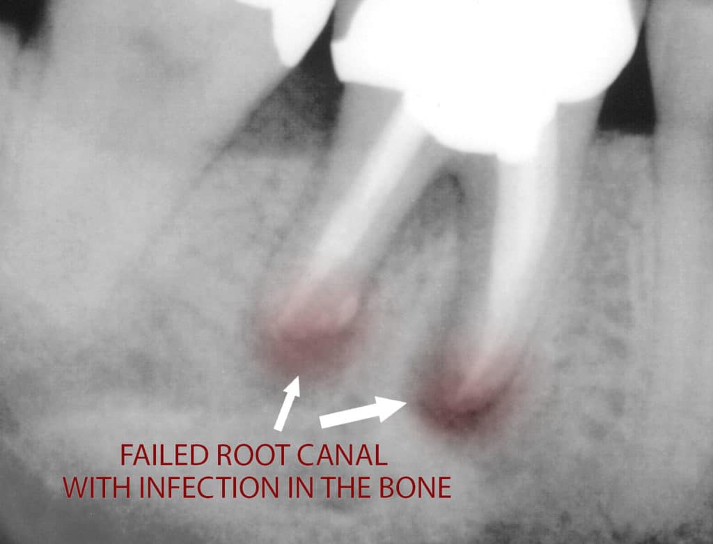 Failed Root Canal in natural teeth that may impact the long term oral health