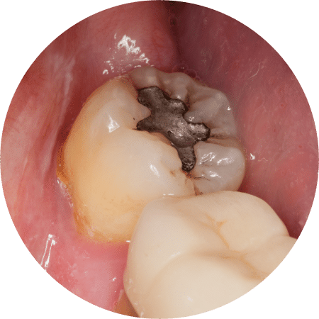 Mercury Fillings