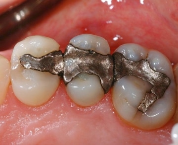 Mercury Fillings