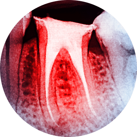 Are root canals safe?