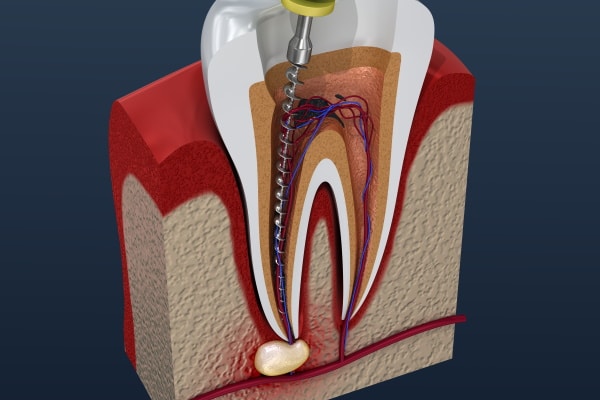 Root Canal - a dental procedure used to save a compromised tooth or an infected tooth