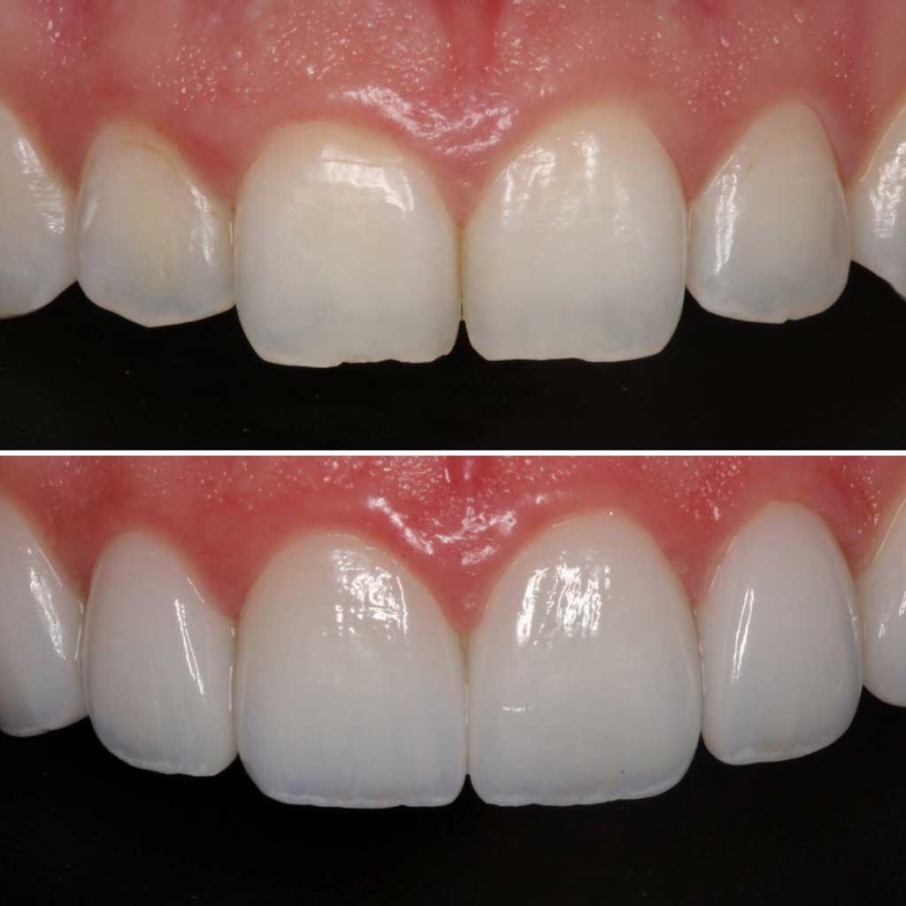 What Are Veneers? Total Care Dental Holistic Dentistry