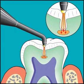 laser cavity detection