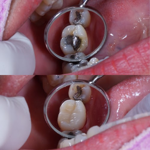 Amalgam filling replacement