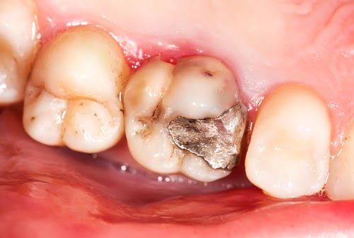 life span of mercury fillings