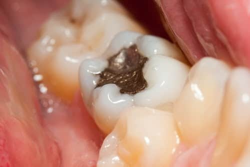 amalgam fillings dangers