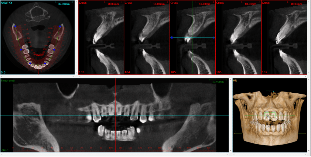 Cone Beam CT Scan