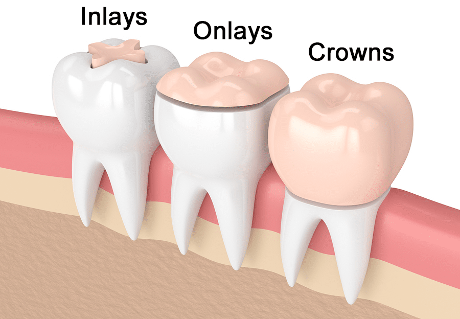 Diagram showing tooth preparation involved with traditional dentistry