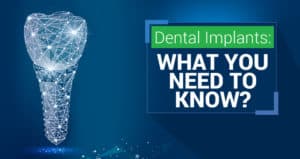 What you need to know about Dental Implants