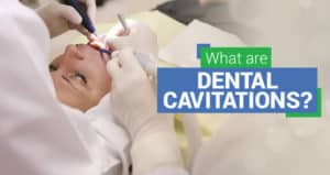 What are dental cavitations