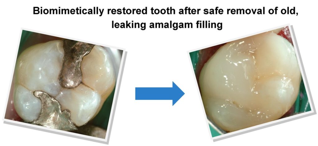 biomimetic dentistry in action. Image showd the change of dental material and preservation of intact tooth structure as evidenced in the final restoration