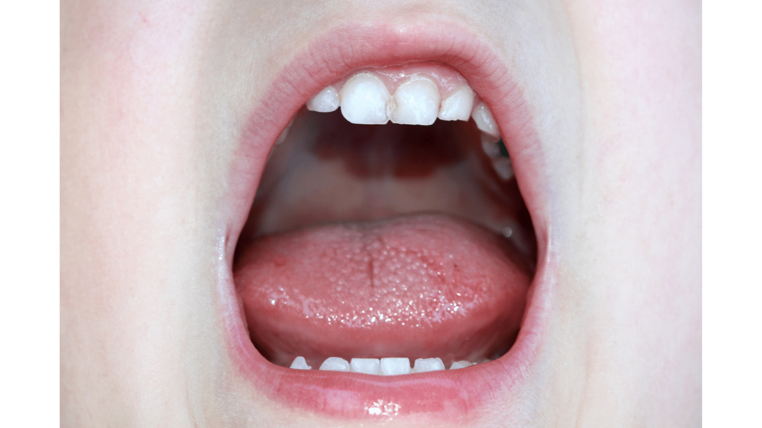 Dry Mouth = Cavities Total Care Dental Holistic Dentistry