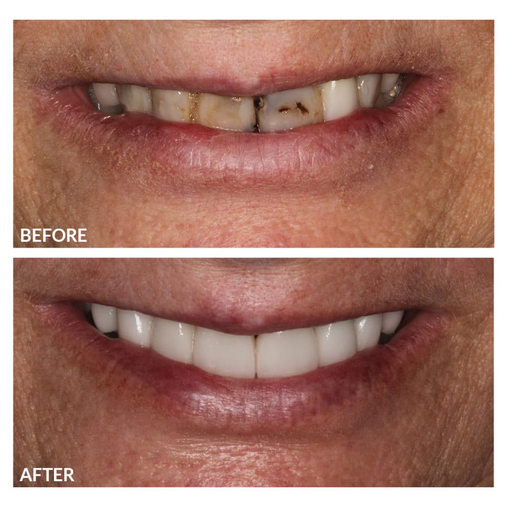 Before and After Photos Of Teeth Care