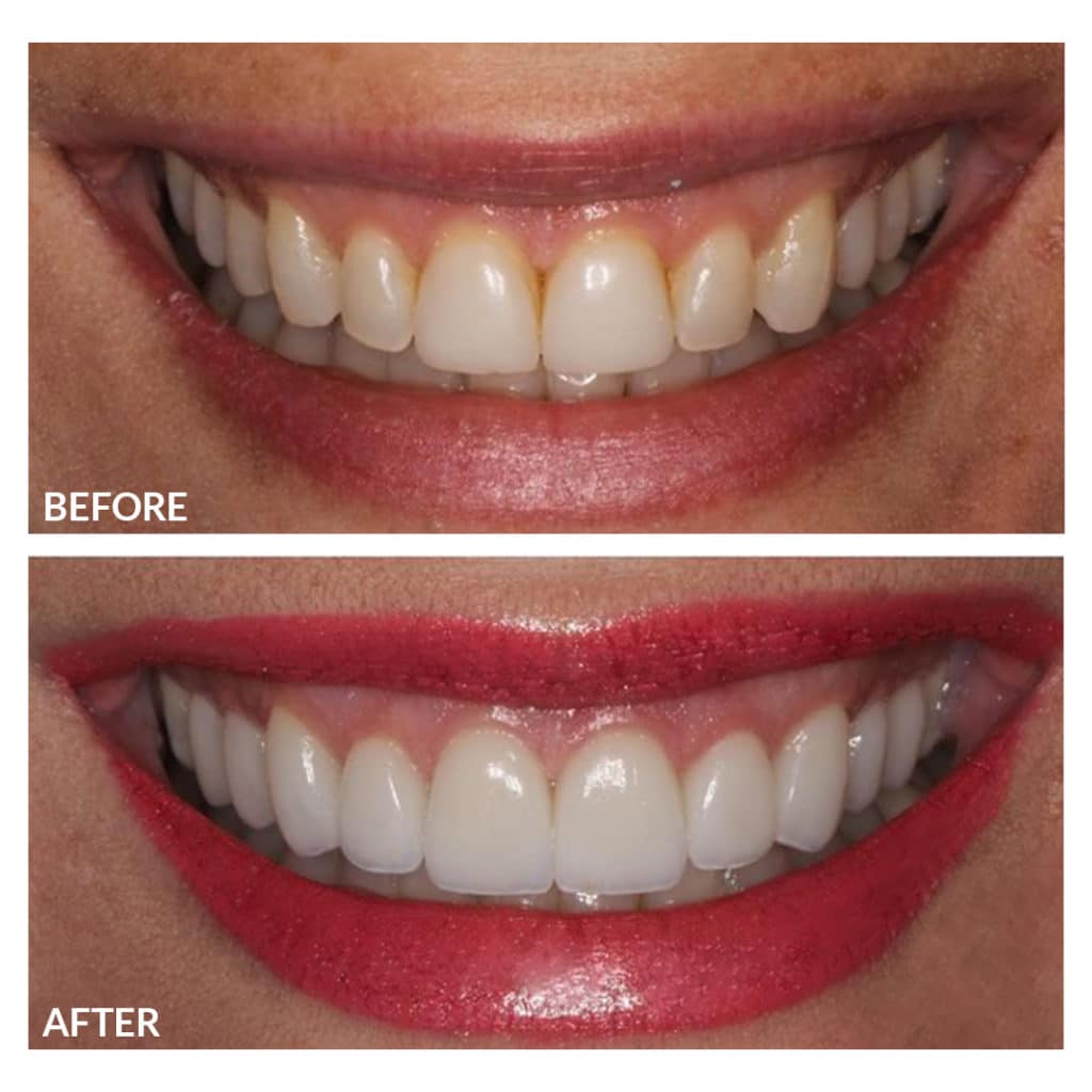 Before and After Photos Of Teeth Care