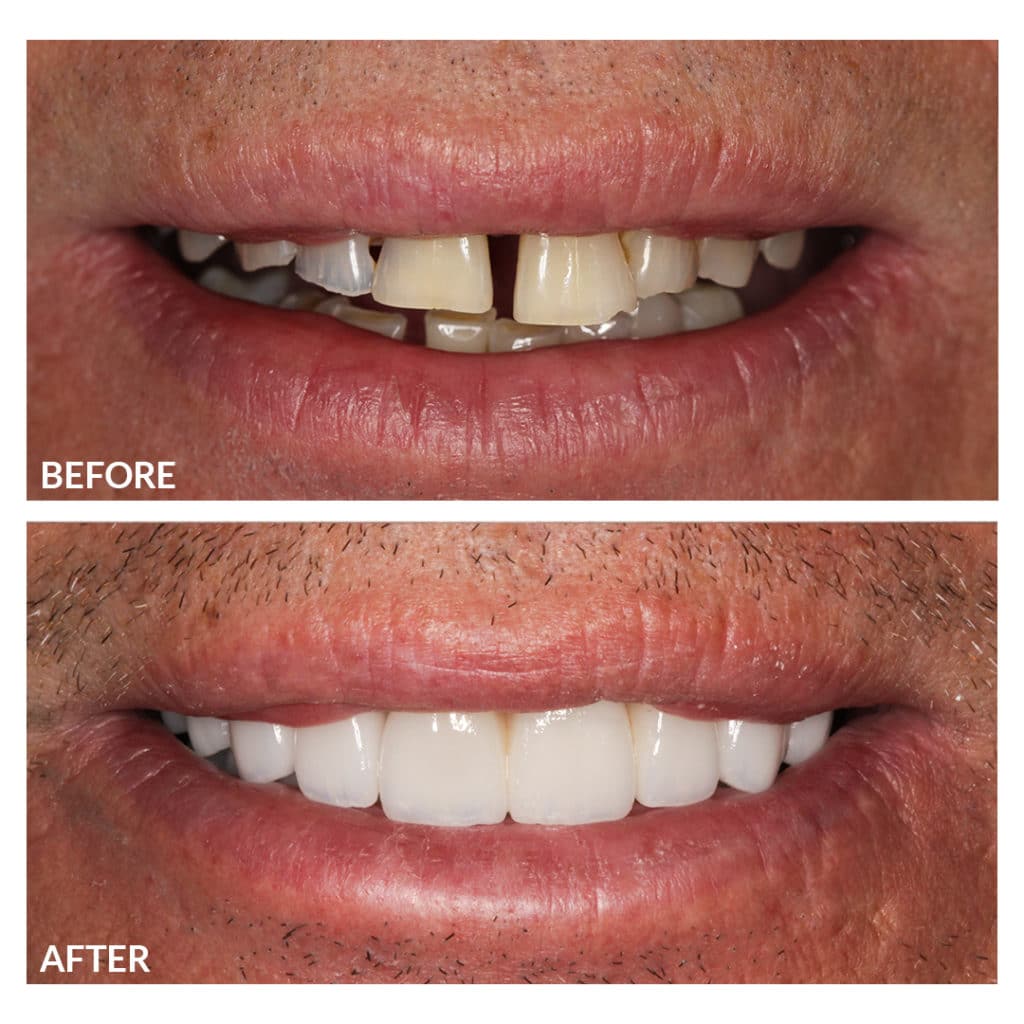 Before and After Photos Of Cosmetic Dentistry
