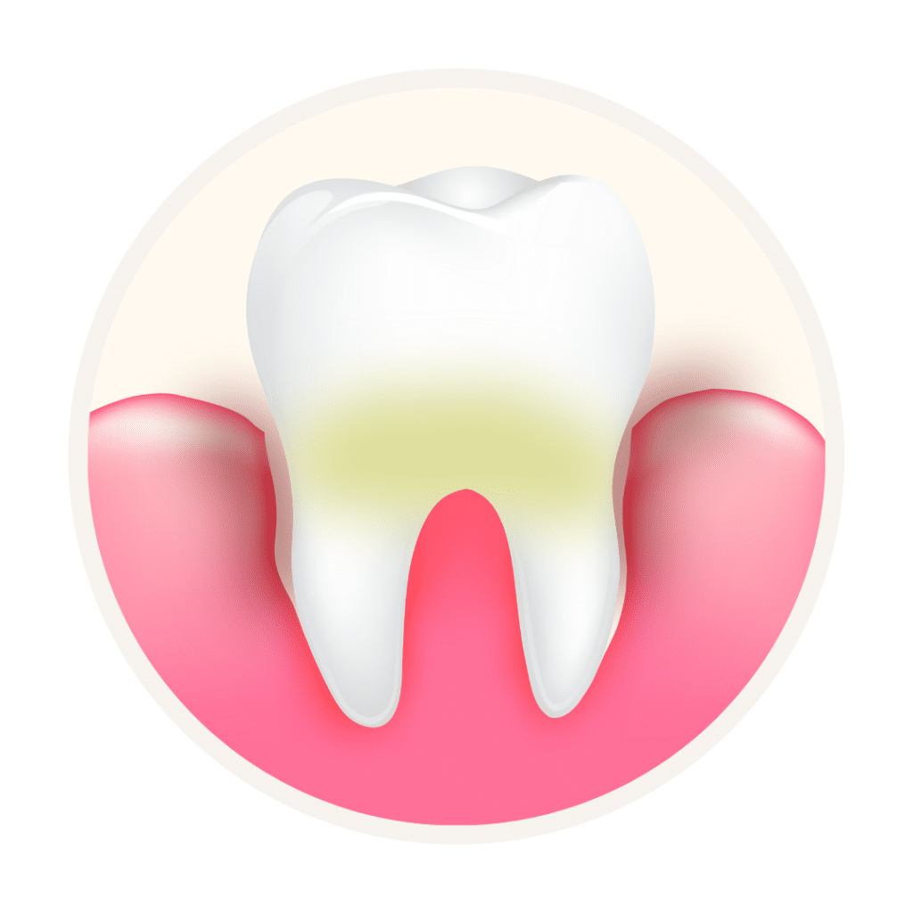 starting of gingivitis