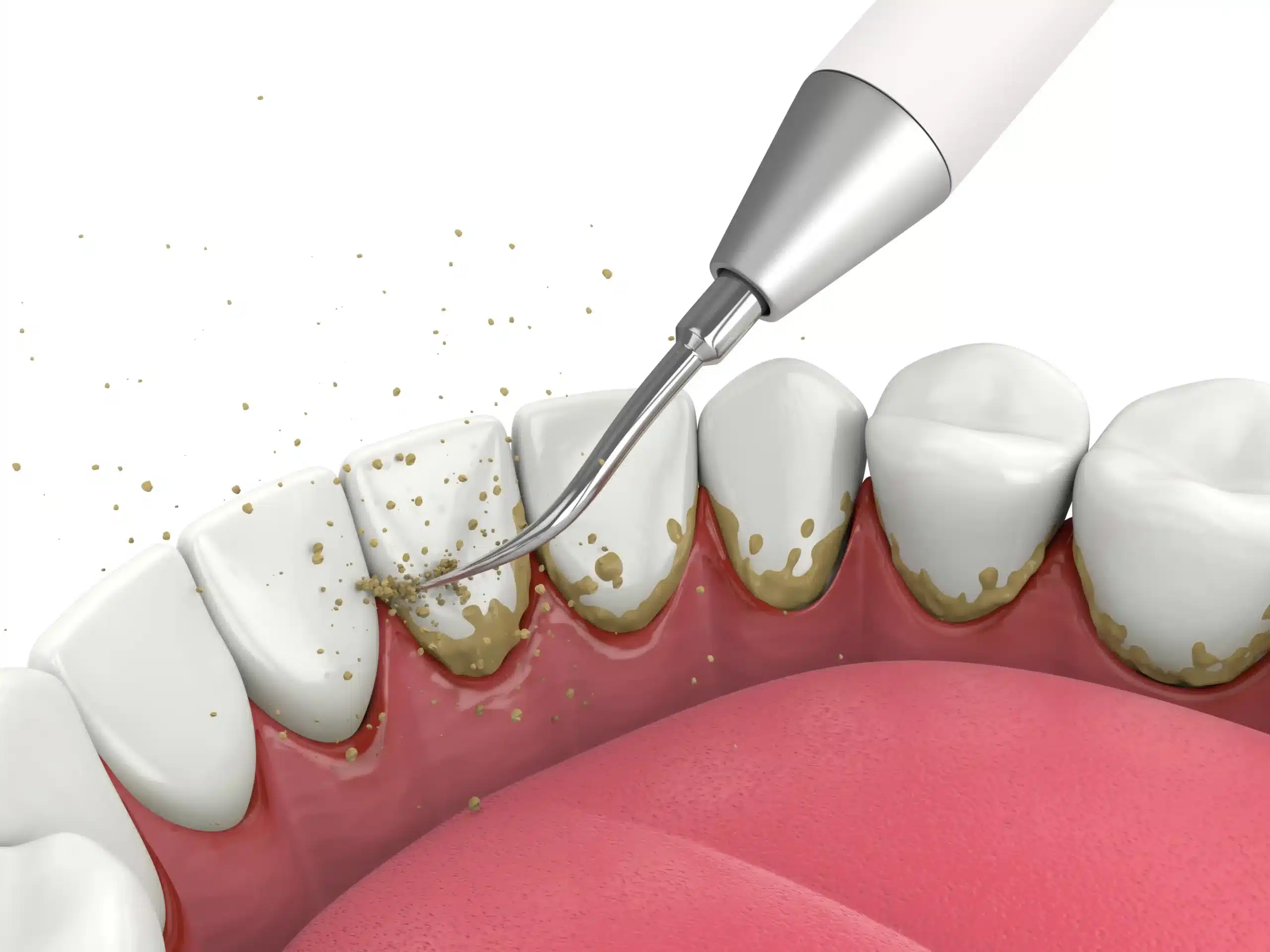 Dental Scaling for gum disease