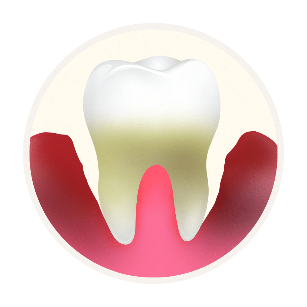 end stage of periodontitis