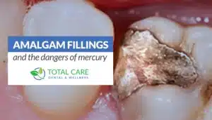 Amalgam Fillings and the Dangers of Mercury