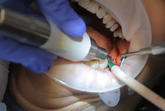 health based oral surgery at Total Care Dental