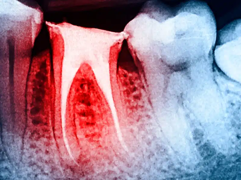 Previous root canal