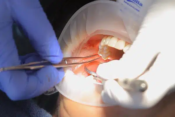 Dental Cavitation Surgery