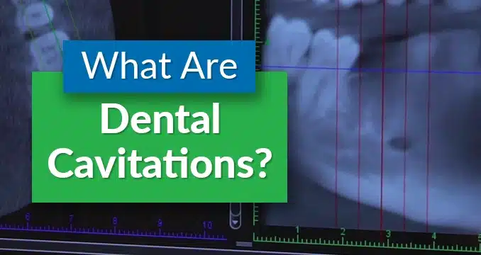 What Are Dental Cavitations Header