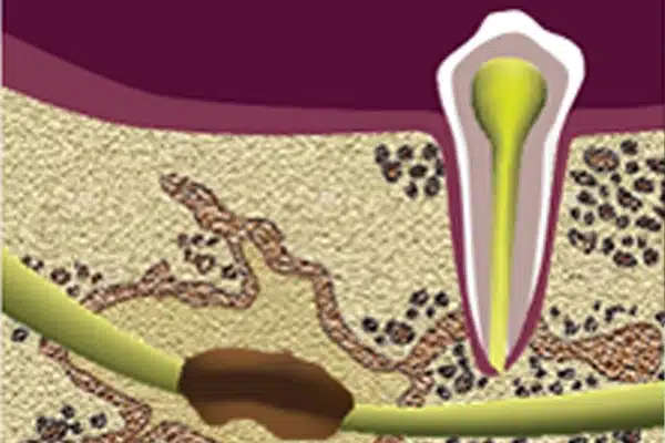 dental cavitation animation with ischemic bone disease