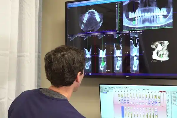 dental cavitation on radiograph exam of the jaw bone