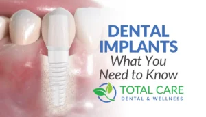 Ceramic Dental Implants Thumbnail