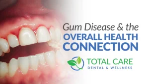 GUM DISEASE AND THE OVERALL HEALTH CONNECTION THUMBNAIL