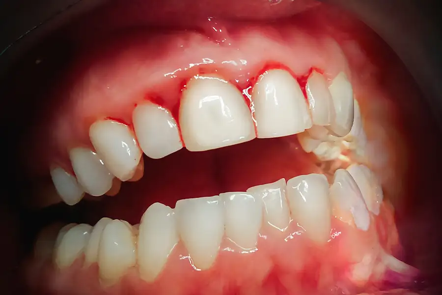 Gum Disease and Inflamed Gums