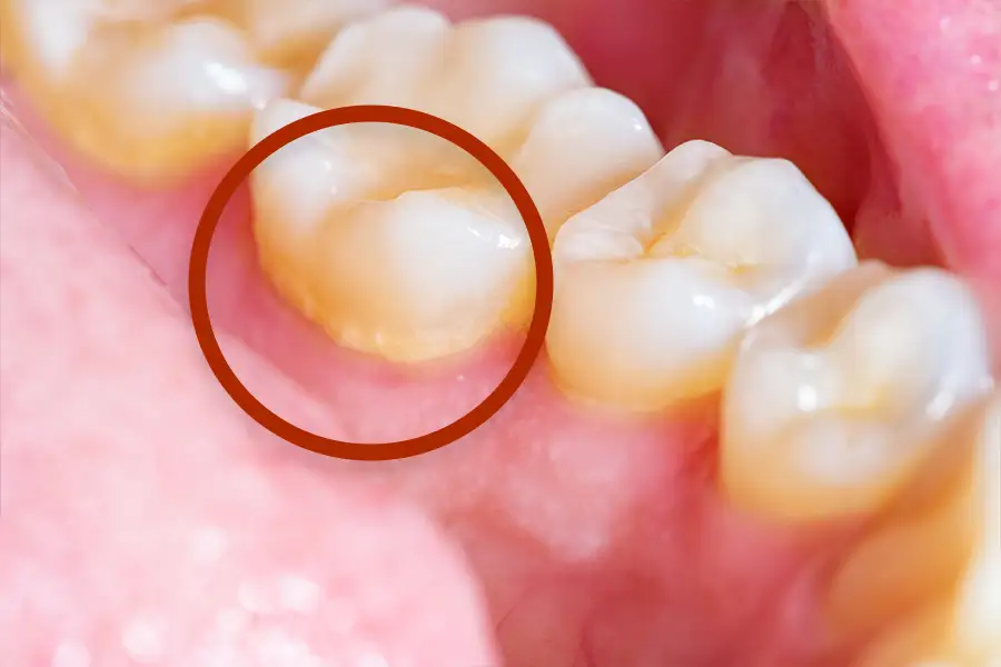 Plaque Buildup Around Gum Line