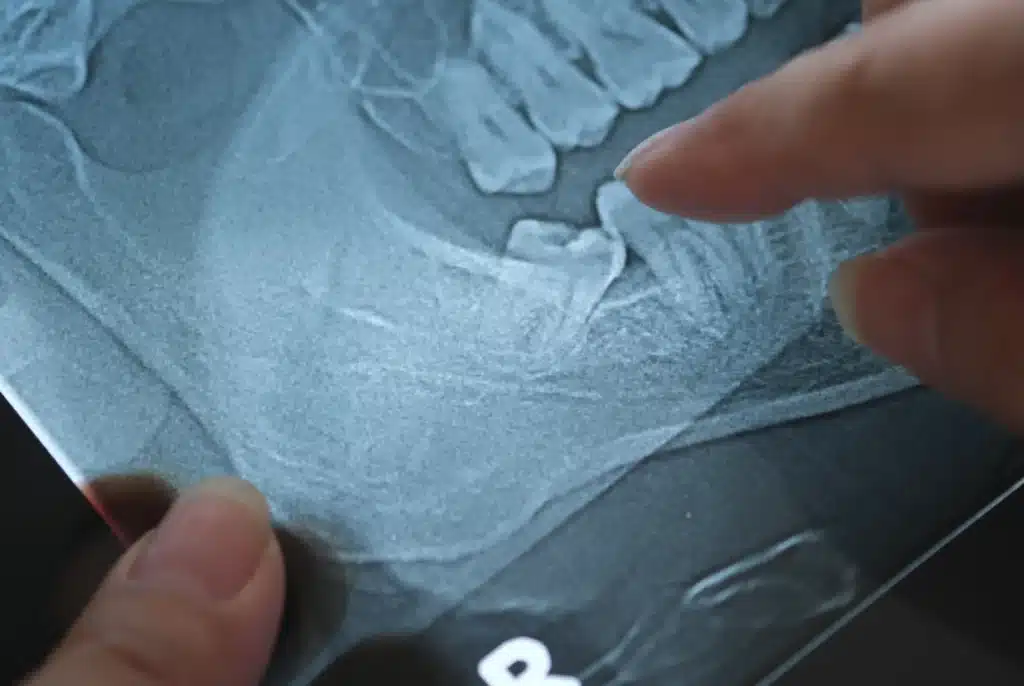 wisdom tooth removal