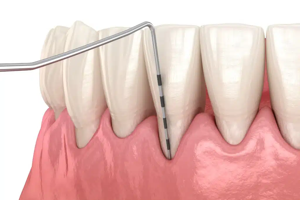 Natural Gum Recession Treatment