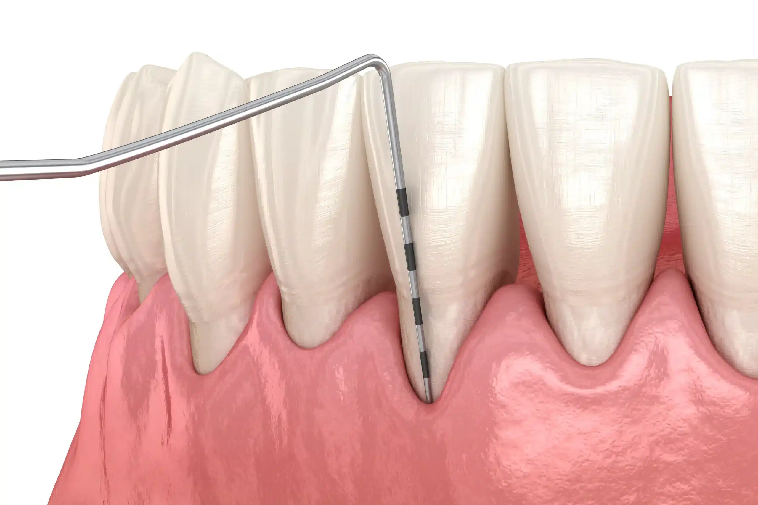 Natural Gum Recession Treatment