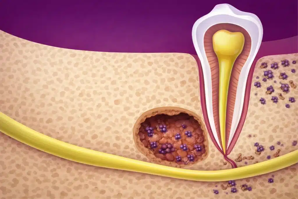 Dental Cavitation Treatment