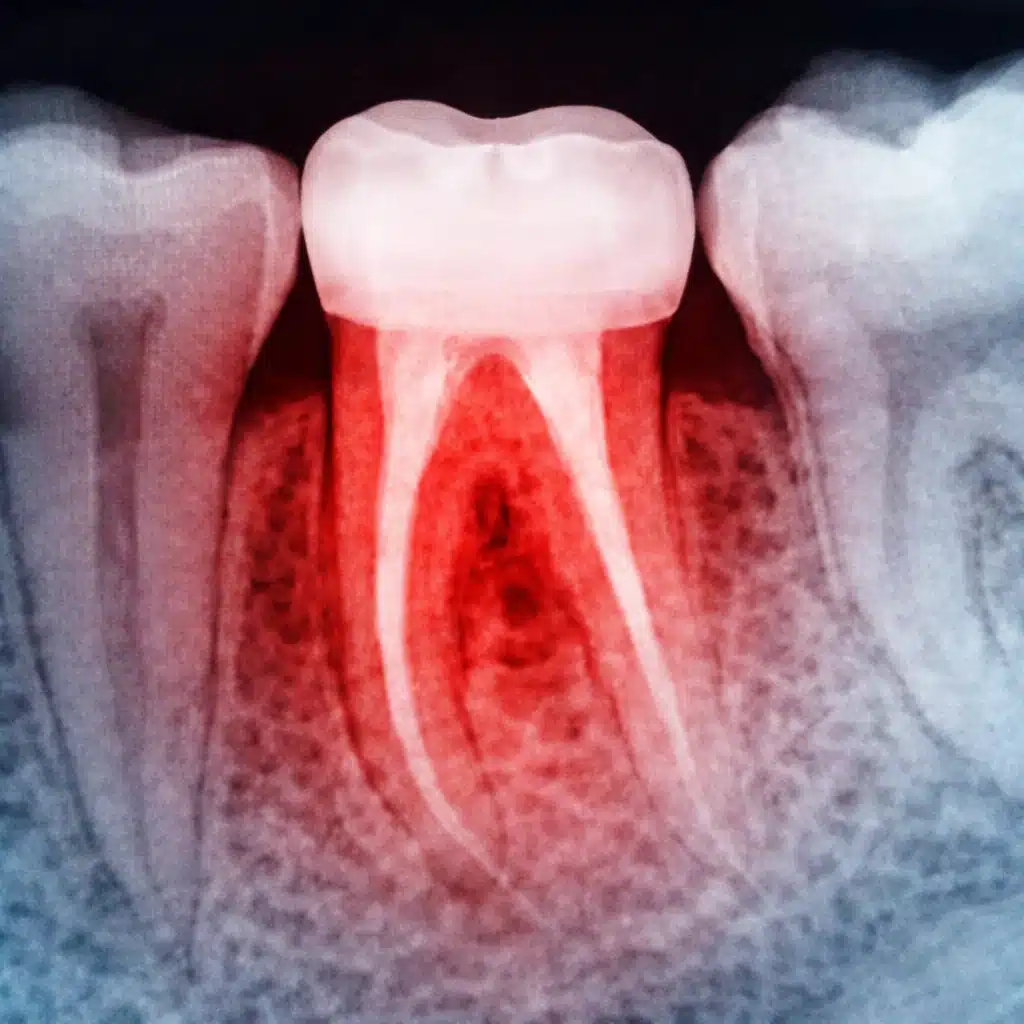 Root canal and crown alternatives